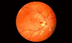 Malignant Hypertension
