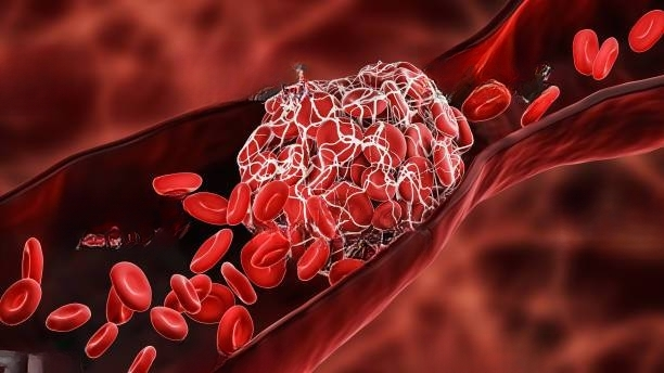 What is Thrombosis